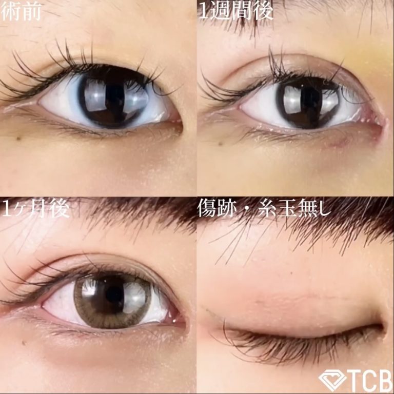 二重埋没法(担当医:TCB 医師)の症例写真1