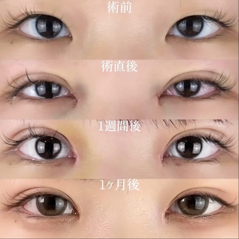 二重埋没法(担当医:TCB 医師)の症例写真2