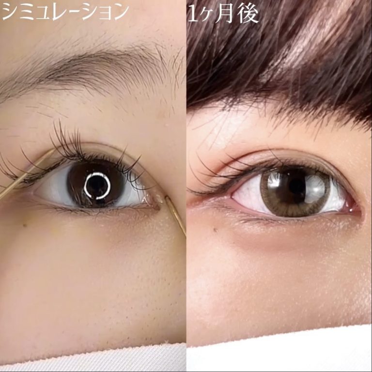 二重埋没法(担当医:TCB 医師)の症例写真3