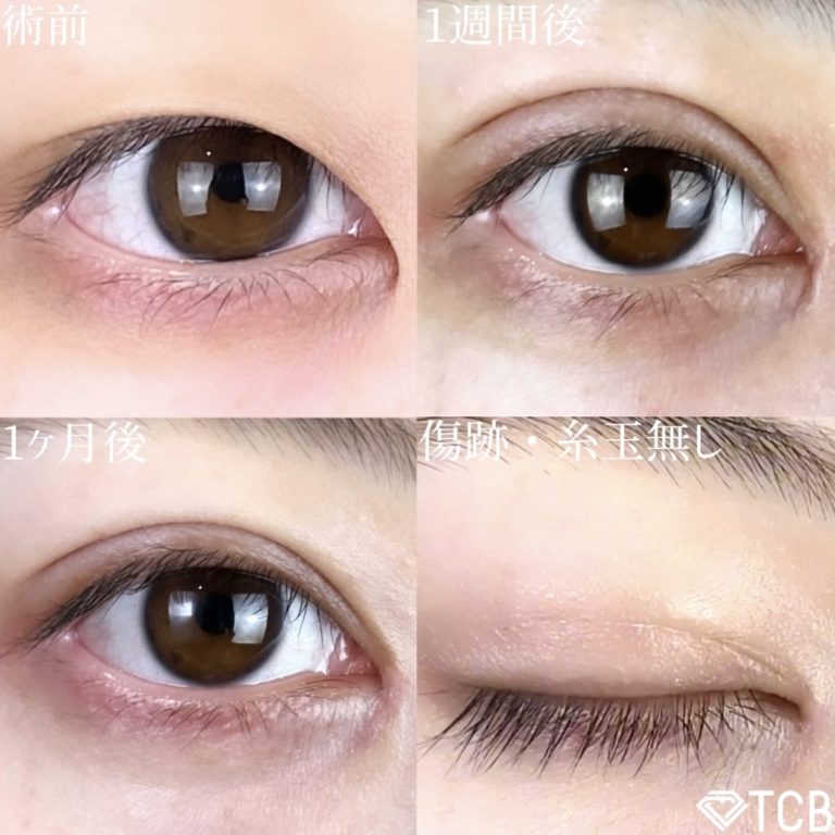 二重埋没法(担当医:TCB 医師)の症例写真1