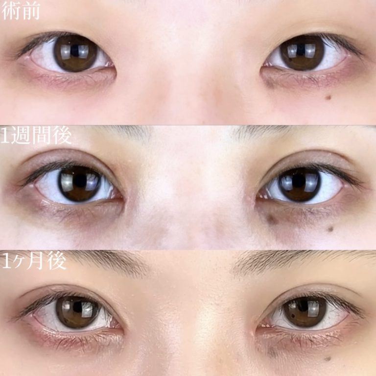 二重埋没法(担当医:TCB 医師)の症例写真2