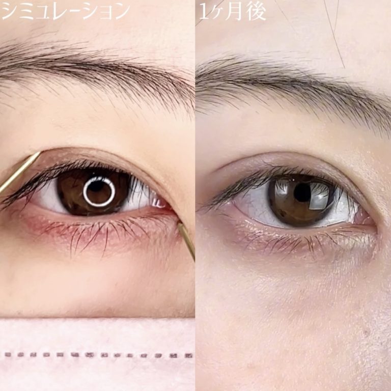 二重埋没法(担当医:TCB 医師)の症例写真3