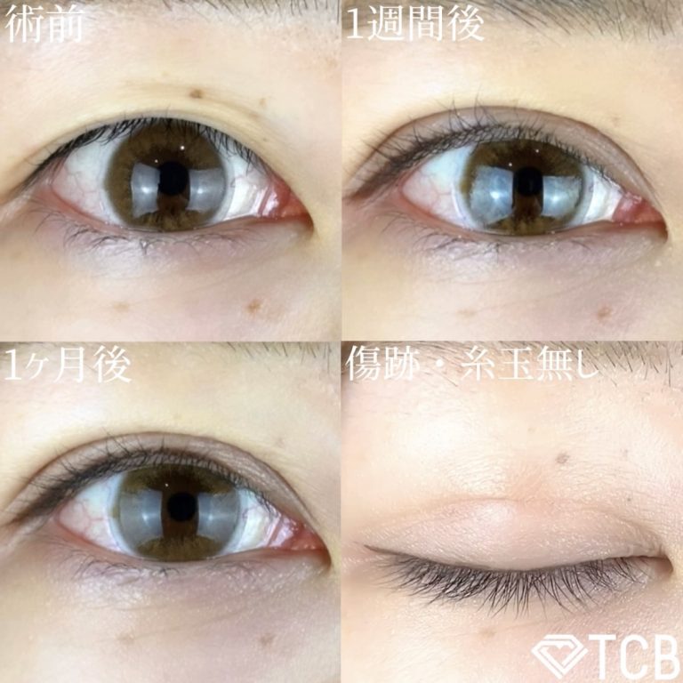 二重埋没法(担当医:TCB 医師)の症例写真1