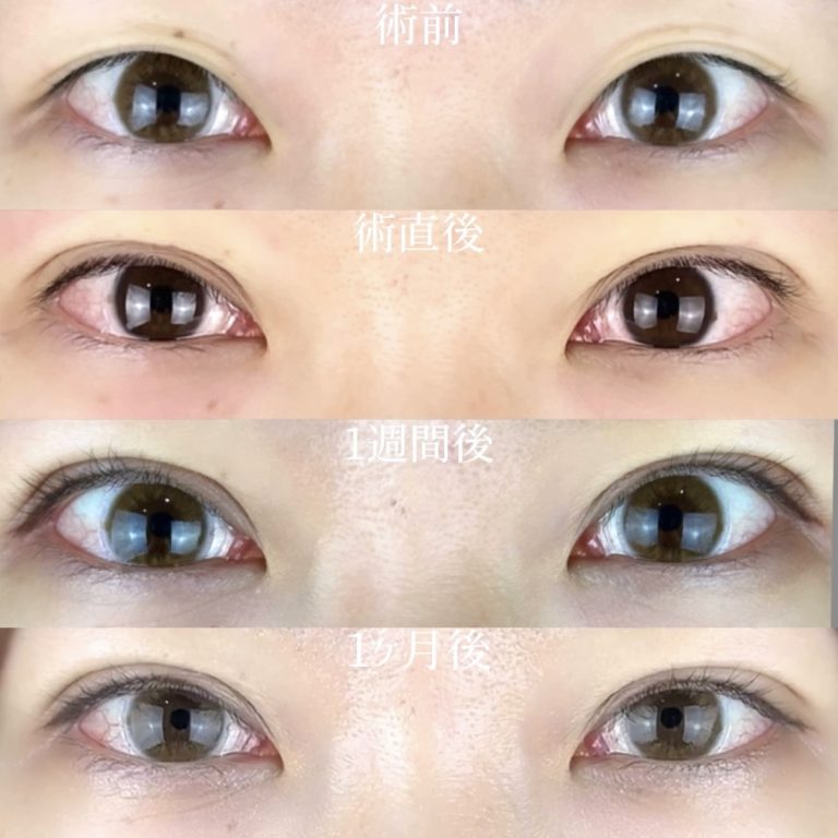 二重埋没法(担当医:TCB 医師)の症例写真2
