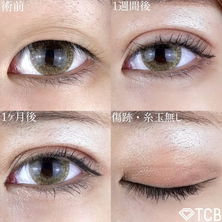 二重埋没法(担当医:TCB 医師)の症例写真1