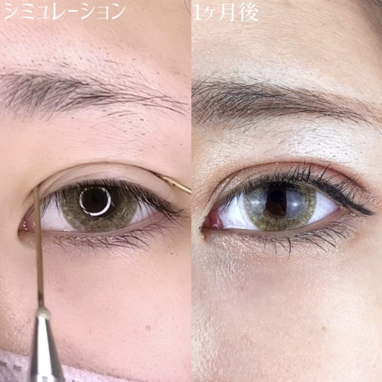 二重埋没法(担当医:TCB 医師)の症例写真3
