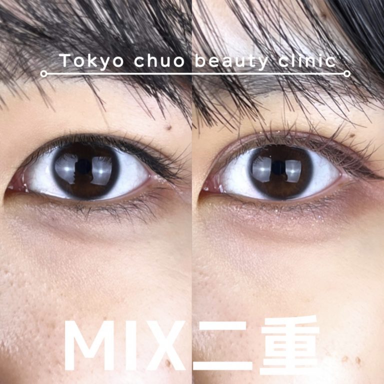 二重埋没法(担当医:TCB 医師)の症例写真1