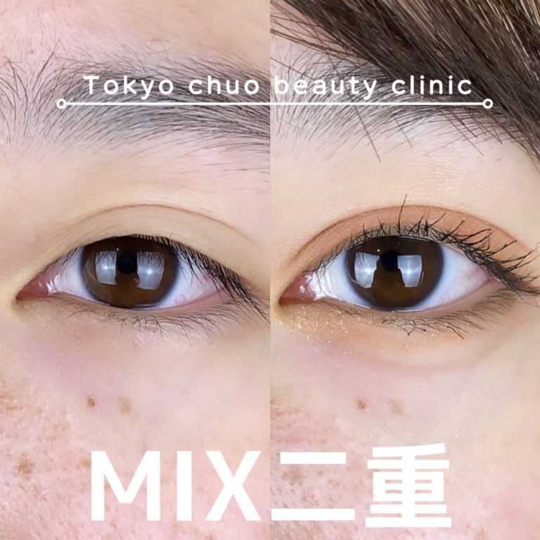二重埋没法(担当医:TCB 医師)の症例写真1
