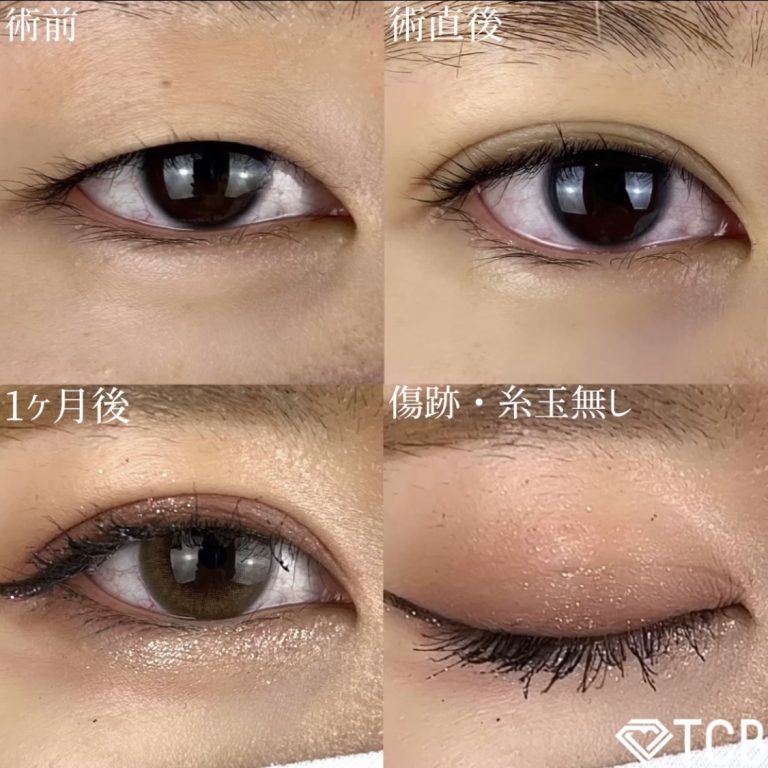 二重埋没法(担当医:TCB 医師)の症例写真1