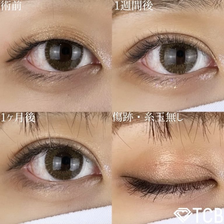 二重埋没法(担当医:TCB 医師)の症例写真1