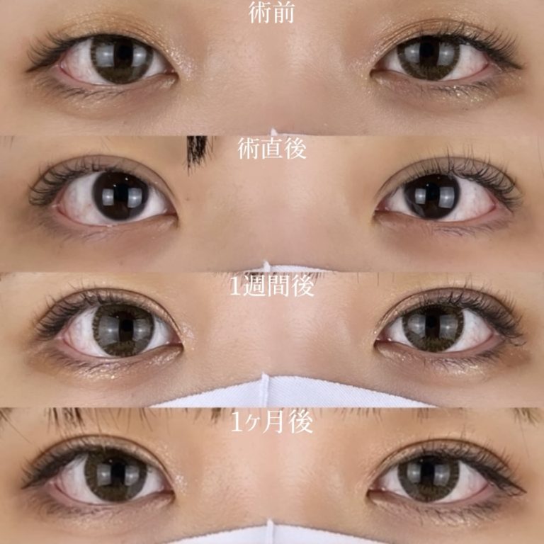 二重埋没法(担当医:TCB 医師)の症例写真2