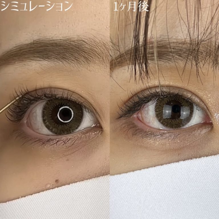 二重埋没法(担当医:TCB 医師)の症例写真3