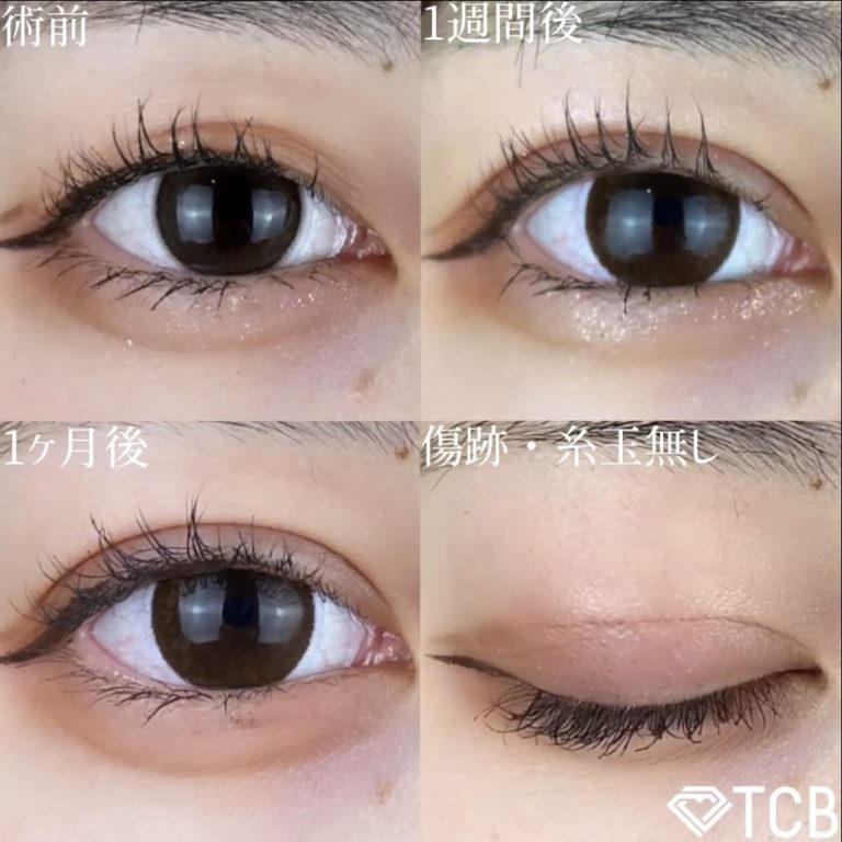 二重埋没法(担当医:TCB 医師)の症例写真1