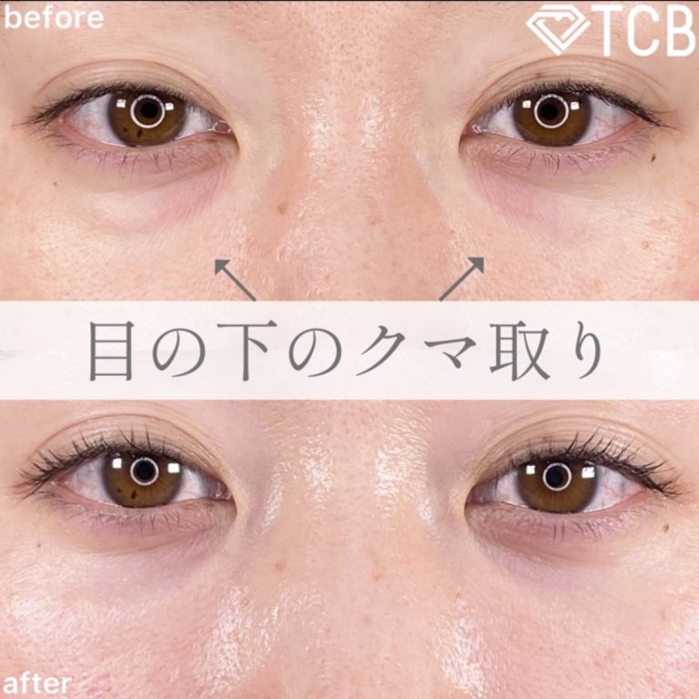 切らない目の下のクマ取り・目の下のたるみ（ふくらみ）取り(担当医:TCB 医師)の症例写真1
