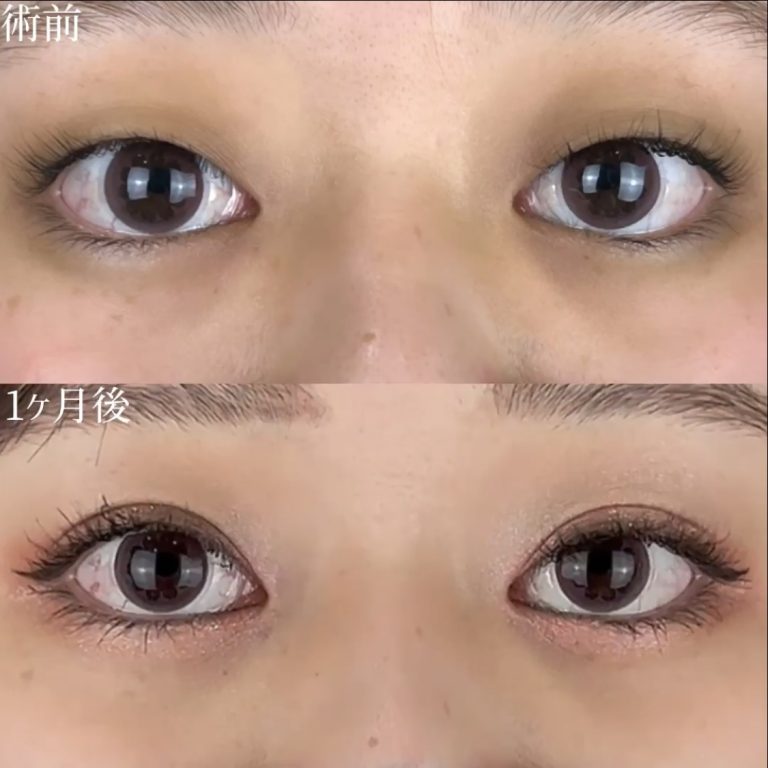 二重埋没法(担当医:TCB 医師)の症例写真2