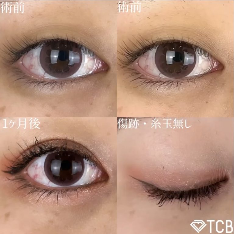 二重埋没法(担当医:TCB 医師)の症例写真1