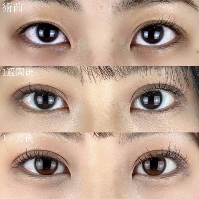 二重埋没法(担当医:TCB 医師)の症例写真2