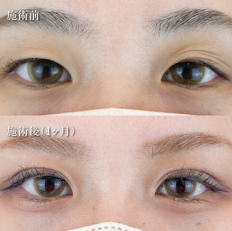 二重埋没法(担当医:TCB 医師)の症例写真1