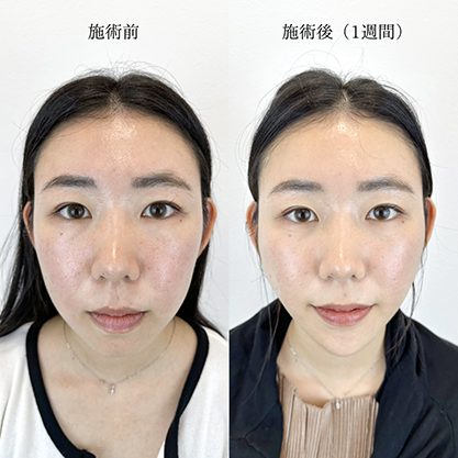 小顔美肌再生（リフトアップ）(担当医:TCB 医師)の症例写真1