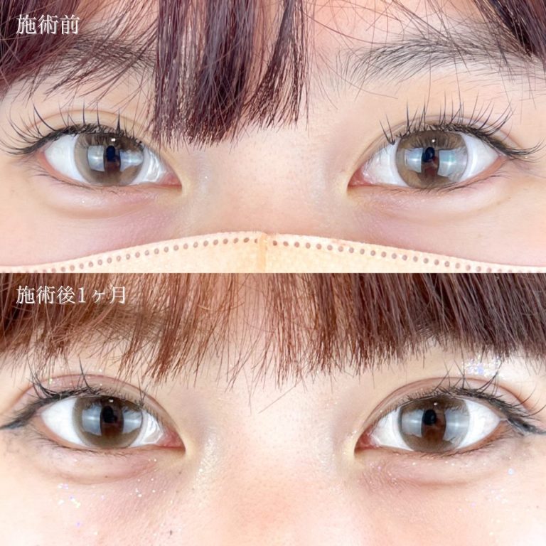 二重埋没法(担当医:TCB 医師)の症例写真1
