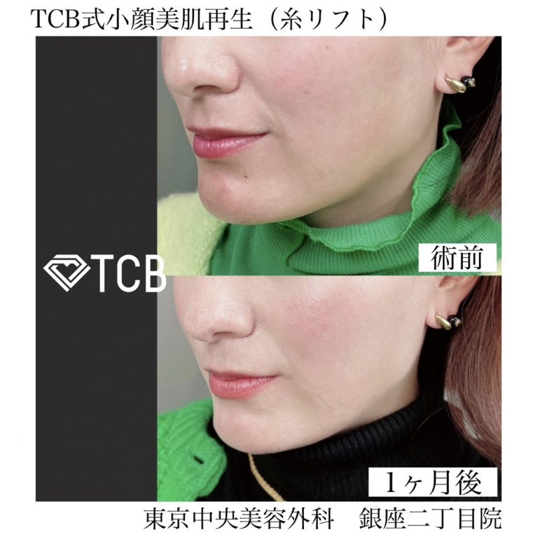 小顔美肌再生（リフトアップ）(担当医:TCB 医師)の症例写真1