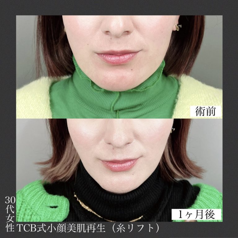 小顔美肌再生（リフトアップ）(担当医:TCB 医師)の症例写真2