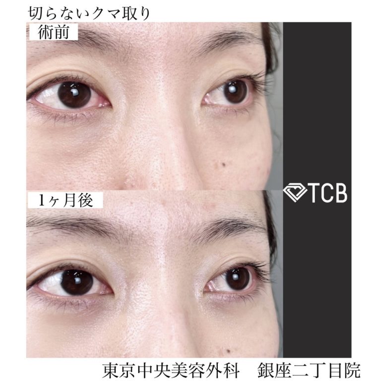 切らない目の下のクマ取り・目の下のたるみ（ふくらみ）取り(担当医:TCB 医師)の症例写真1
