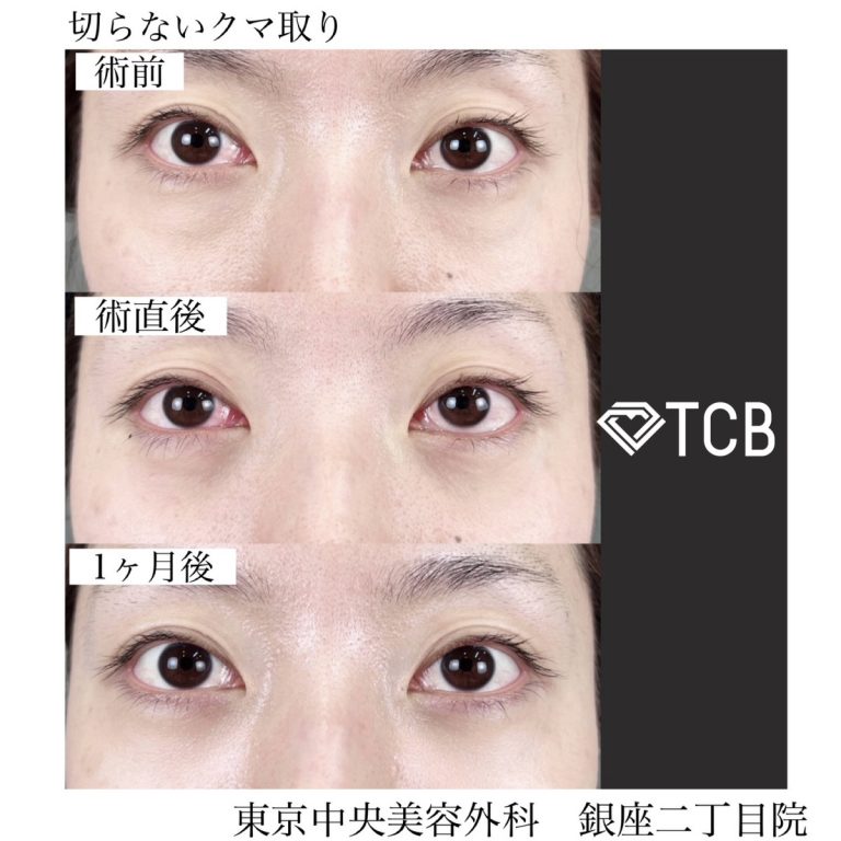 切らない目の下のクマ取り・目の下のたるみ（ふくらみ）取り(担当医:TCB 医師)の症例写真2
