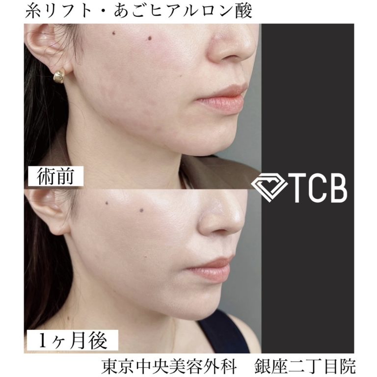 小顔美肌再生（リフトアップ）(担当医:TCB 医師)の症例写真1