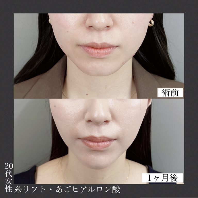 小顔美肌再生（リフトアップ）(担当医:TCB 医師)の症例写真2