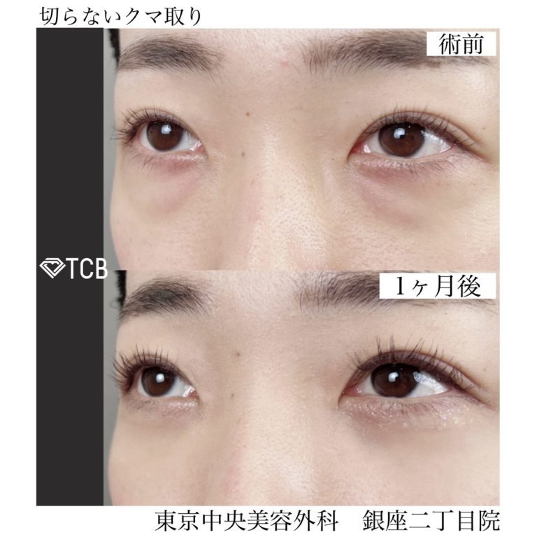切らない目の下のクマ取り・目の下のたるみ（ふくらみ）取り(担当医:TCB 医師)の症例写真1