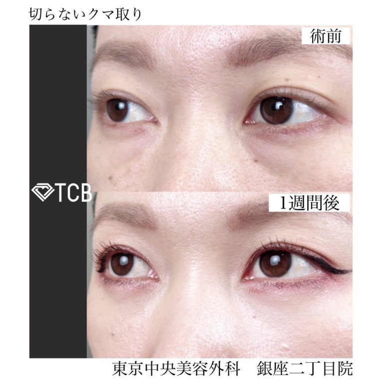 切らない目の下のクマ取り・目の下のたるみ（ふくらみ）取り(担当医:TCB 医師)の症例写真1