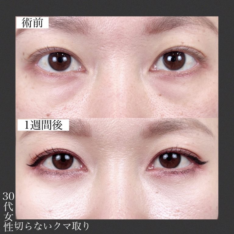 切らない目の下のクマ取り・目の下のたるみ（ふくらみ）取り(担当医:TCB 医師)の症例写真2