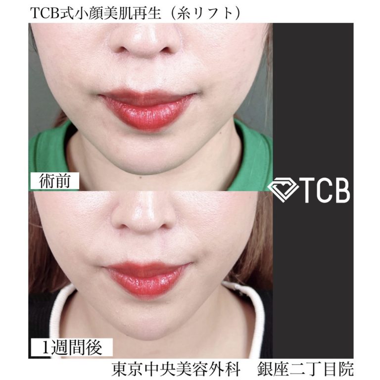 小顔美肌再生（リフトアップ）(担当医:TCB 医師)の症例写真1