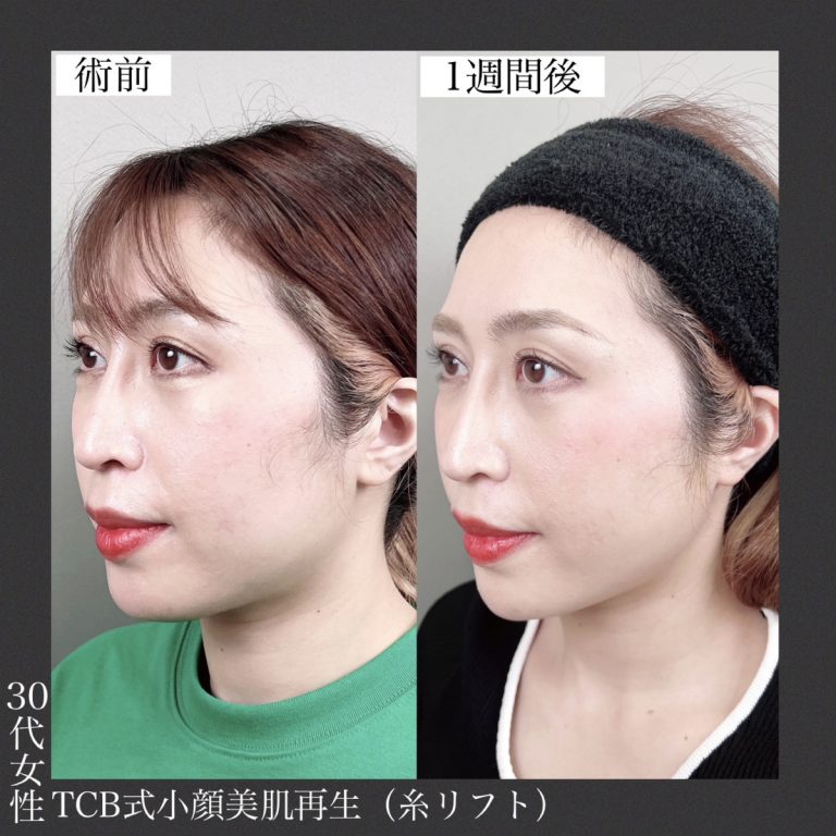 小顔美肌再生（リフトアップ）(担当医:TCB 医師)の症例写真2