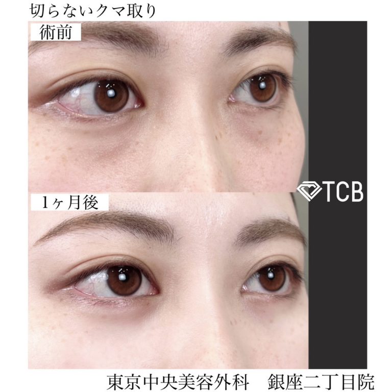 切らない目の下のクマ取り・目の下のたるみ（ふくらみ）取り(担当医:TCB 医師)の症例写真1