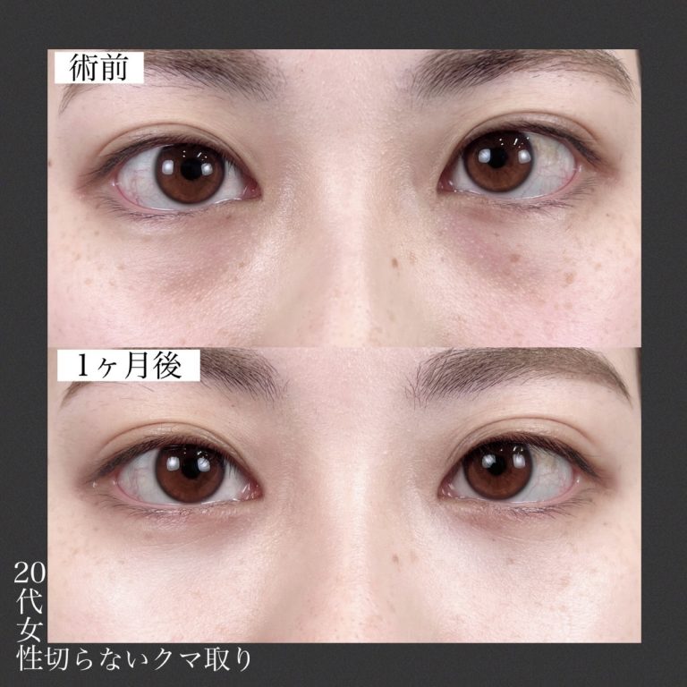 切らない目の下のクマ取り・目の下のたるみ（ふくらみ）取り(担当医:TCB 医師)の症例写真2