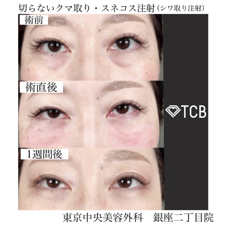 切らない目の下のクマ取り・目の下のたるみ（ふくらみ）取り(担当医:TCB 医師)の症例写真1