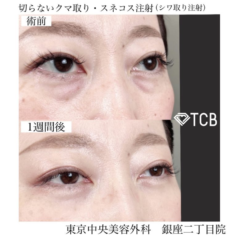 切らない目の下のクマ取り・目の下のたるみ（ふくらみ）取り(担当医:TCB 医師)の症例写真2