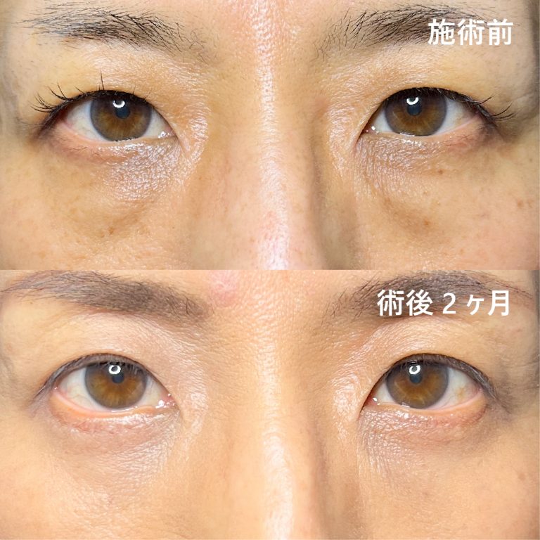 切開法による目の下のたるみ取り（下眼瞼除皺術）(担当医:坂田 将彰 医師)の症例写真1