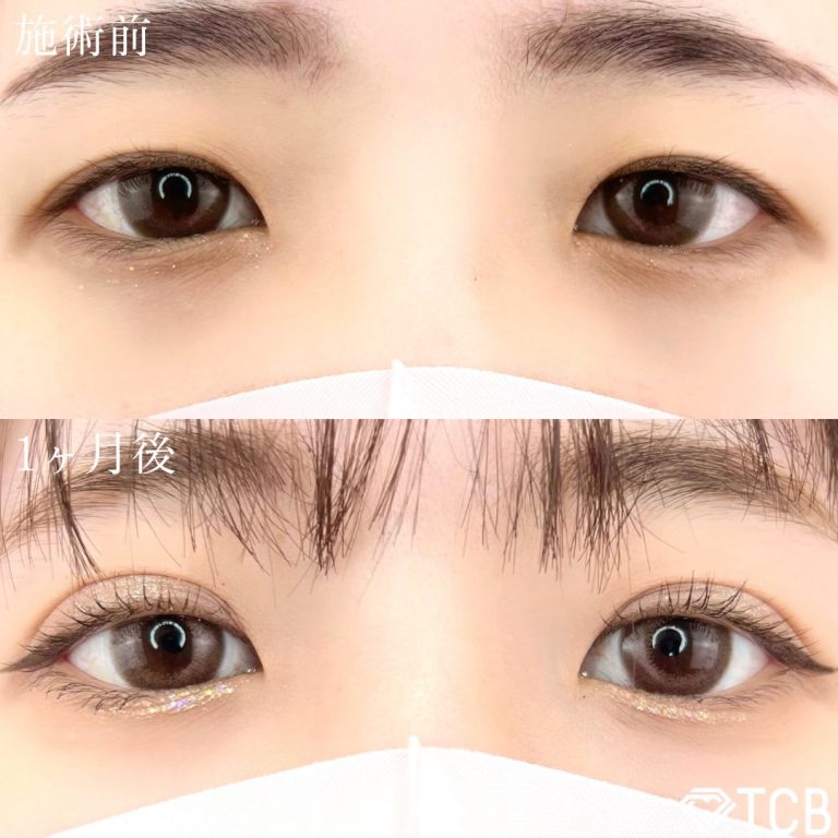 二重埋没法(担当医:津金 雄太 医師)の症例写真1