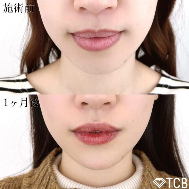 切らない顎形成 3D Eライン(担当医:TCB 医師)の症例写真3