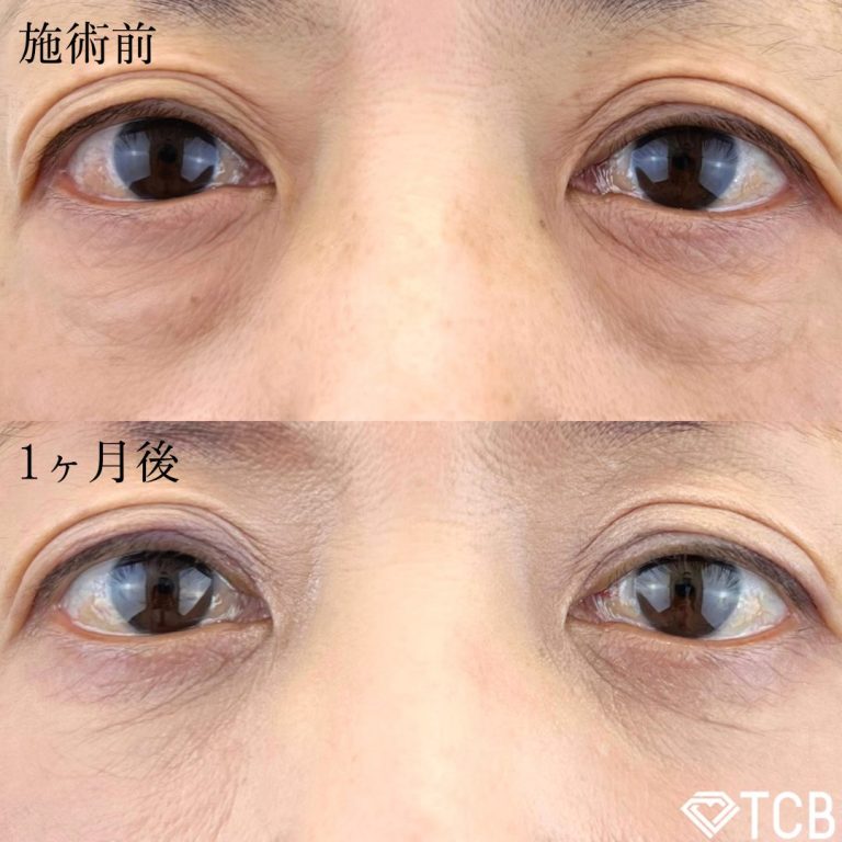 切らない目の下のクマ取り・目の下のたるみ（ふくらみ）取り(担当医:TCB 医師)の症例写真1
