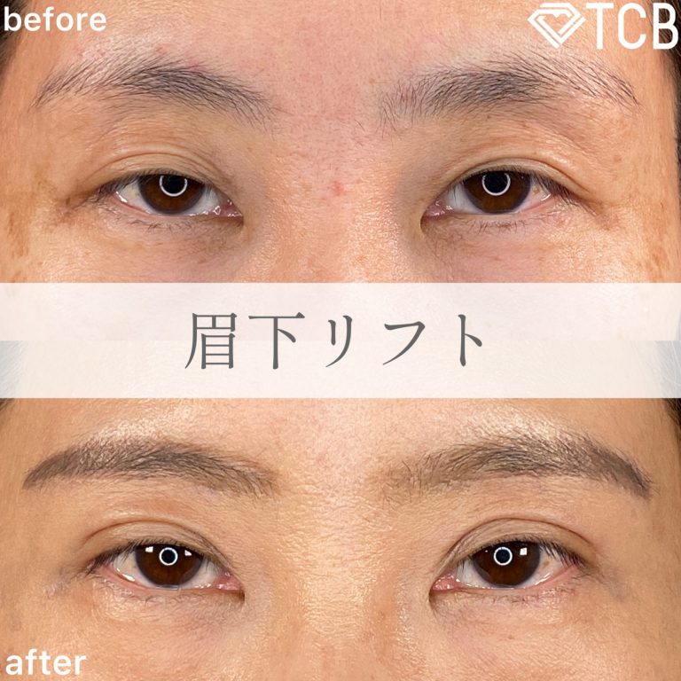 切らない目の下のクマ取り・目の下のたるみ（ふくらみ）取り(担当医:TCB 医師)の症例写真1