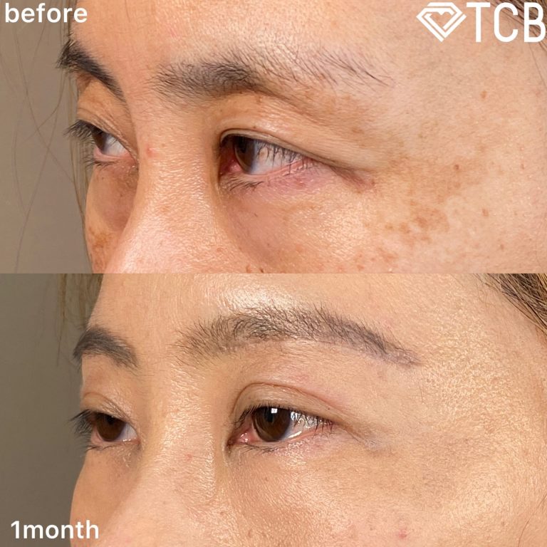 切らない目の下のクマ取り・目の下のたるみ（ふくらみ）取り(担当医:TCB 医師)の症例写真3