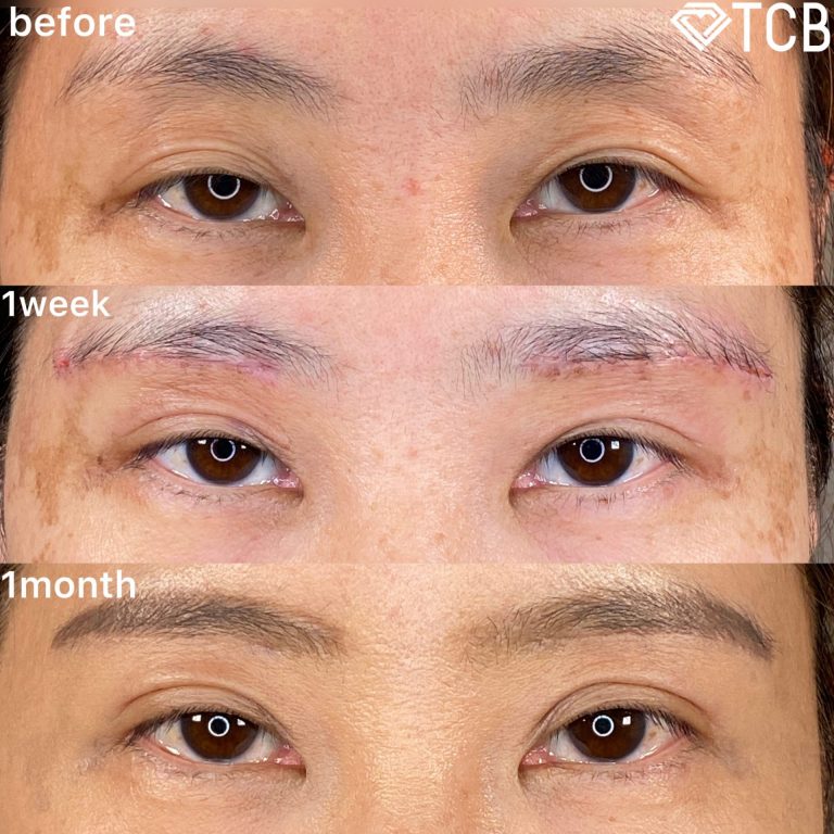 切らない目の下のクマ取り・目の下のたるみ（ふくらみ）取り(担当医:TCB 医師)の症例写真4