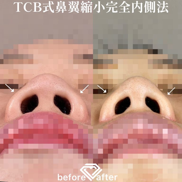 TCB式鼻翼縮小完全内側法(担当医:森本 理一郎 医師)の症例写真2