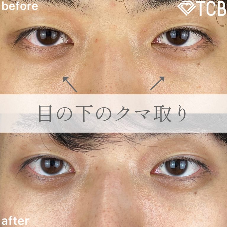 切らない目の下のクマ取り・目の下のたるみ（ふくらみ）取り(担当医:TCB 医師)の症例写真1