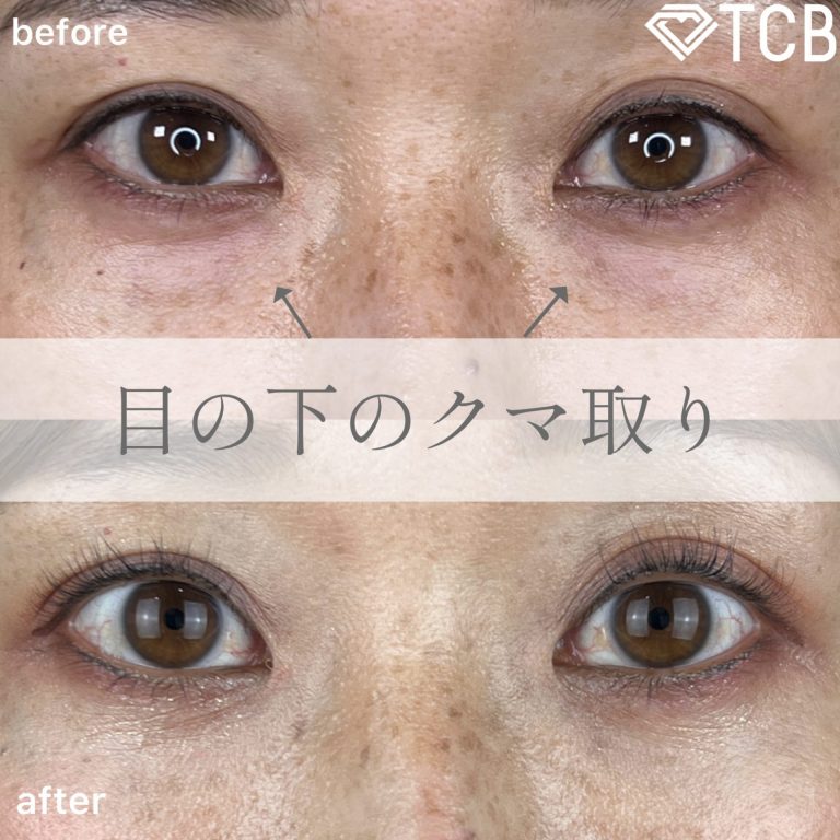 切らない目の下のクマ取り・目の下のたるみ（ふくらみ）取り(担当医:TCB 医師)の症例写真1