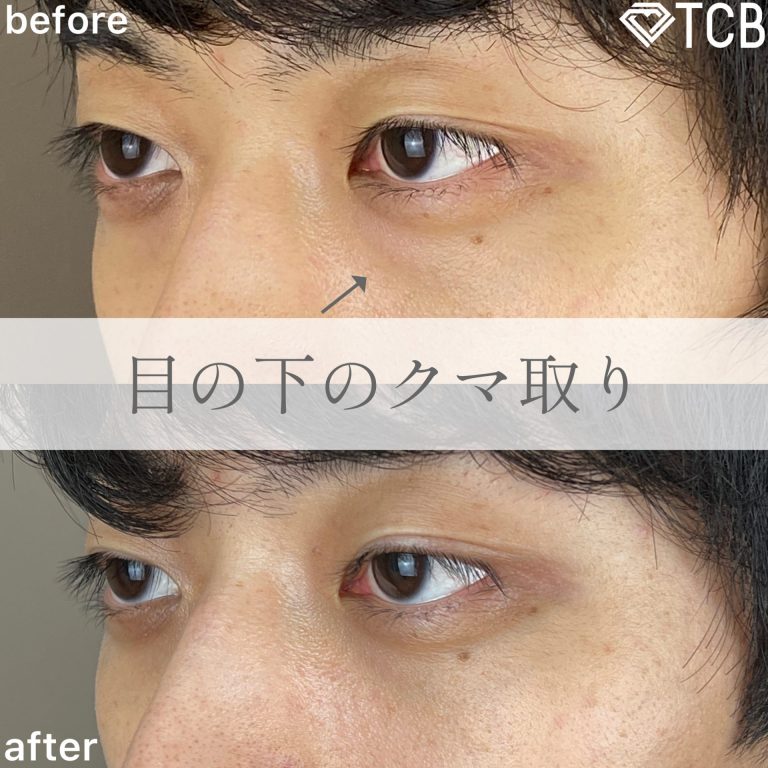 切らない目の下のクマ取り・目の下のたるみ（ふくらみ）取り(担当医:TCB 医師)の症例写真2